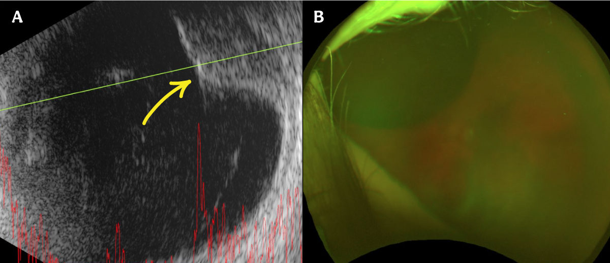 https://covalentcareers3.s3.amazonaws.com/media/original_images/The-Ultimate-Guide-to-Diagnosing-a-Choroidal-Nevus_Images_Malignant-Melano.png