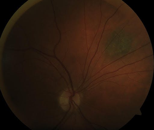 https://covalentcareers3.s3.amazonaws.com/media/original_images/Typical_Choroidal_Nevi_with_Small_Drusen.jpg