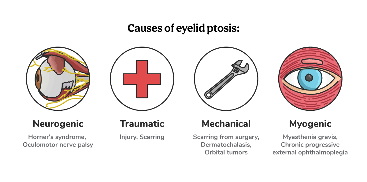 https://covalentcareers3.s3.amazonaws.com/media/original_images/Ultimate-Guide_Ptosis_In-Line-Images_Causes.png