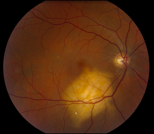 https://covalentcareers3.s3.amazonaws.com/media/original_images/Uterine_Cancer_with_Choroidal_Metastasis.png