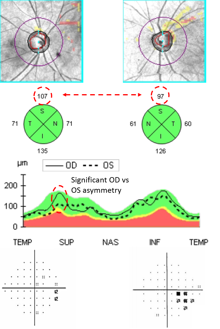 https://covalentcareers3.s3.amazonaws.com/media/original_images/Visual_Field_and_Retinal_Nerve_Fiber_Layer_OCT_YDXNNxu.png