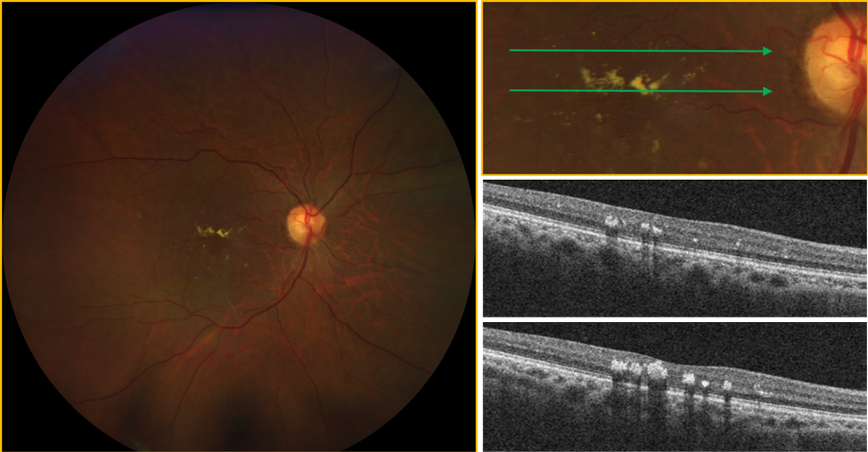 https://covalentcareers3.s3.amazonaws.com/media/original_images/calrus-500-diabetic-retinopathy-exudates.png