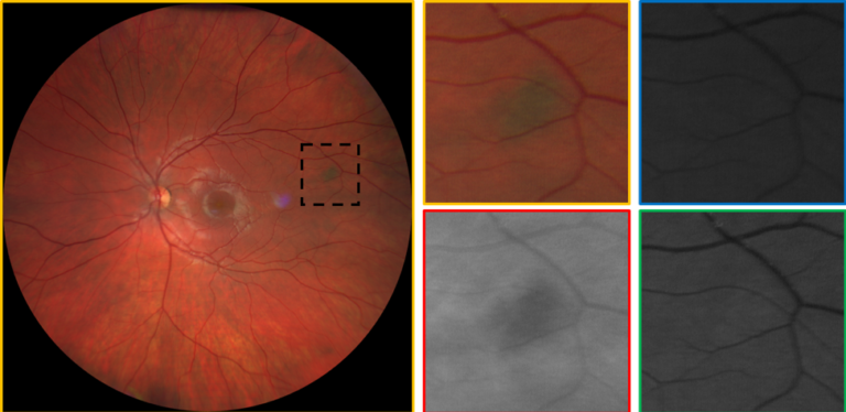 https://covalentcareers3.s3.amazonaws.com/media/original_images/clarus-500-choroidal-nevus-768x374.png