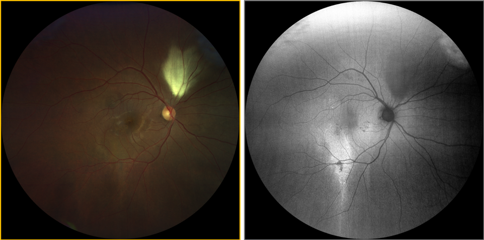 https://covalentcareers3.s3.amazonaws.com/media/original_images/clarus-500-multifocal-retinal-atrophy.png