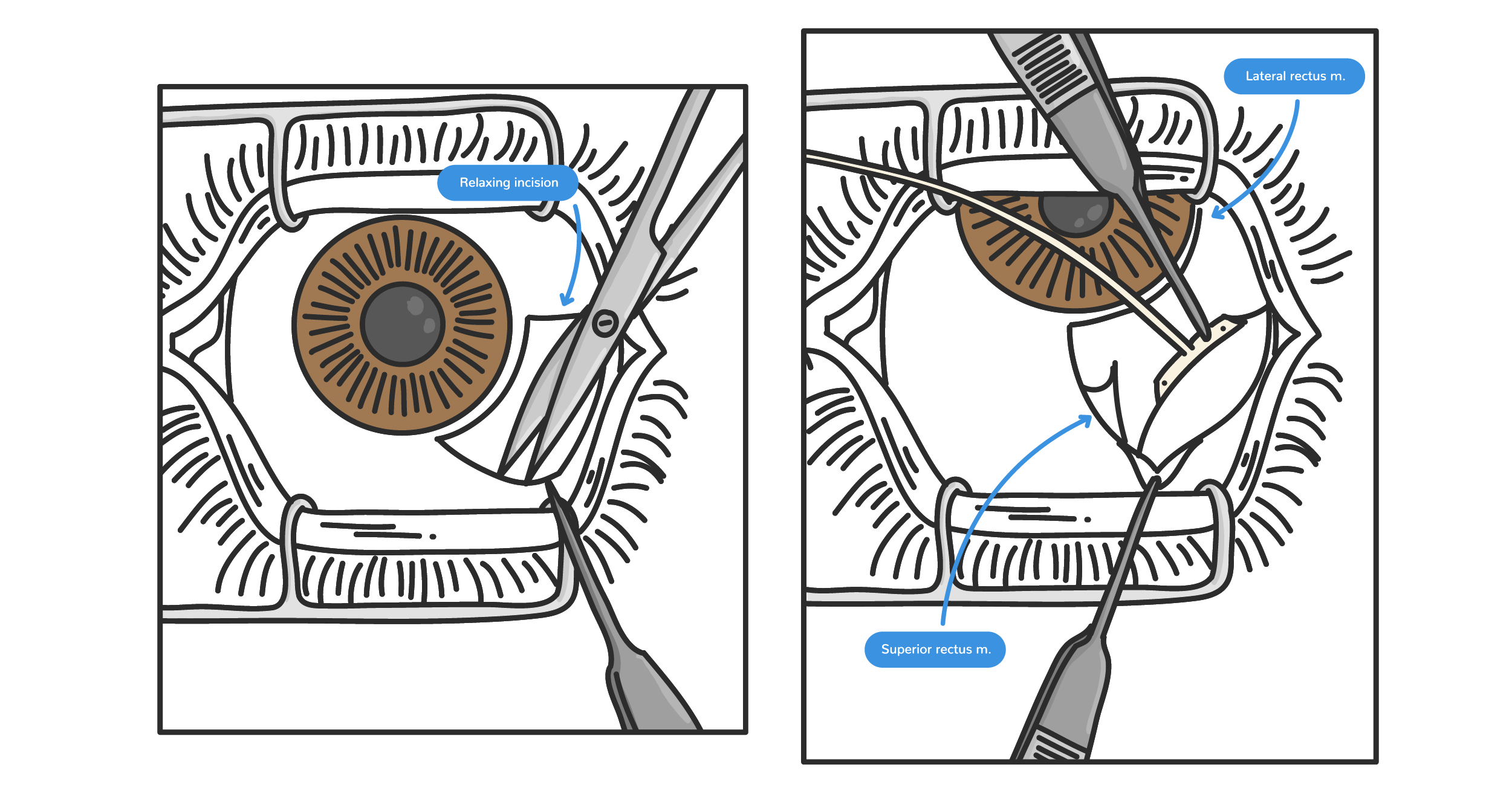 https://covalentcareers3.s3.amazonaws.com/media/original_images/conjunctival_peritomy_tube_shunt.png