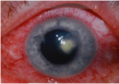 https://covalentcareers3.s3.amazonaws.com/media/original_images/corneal_ulcer.png