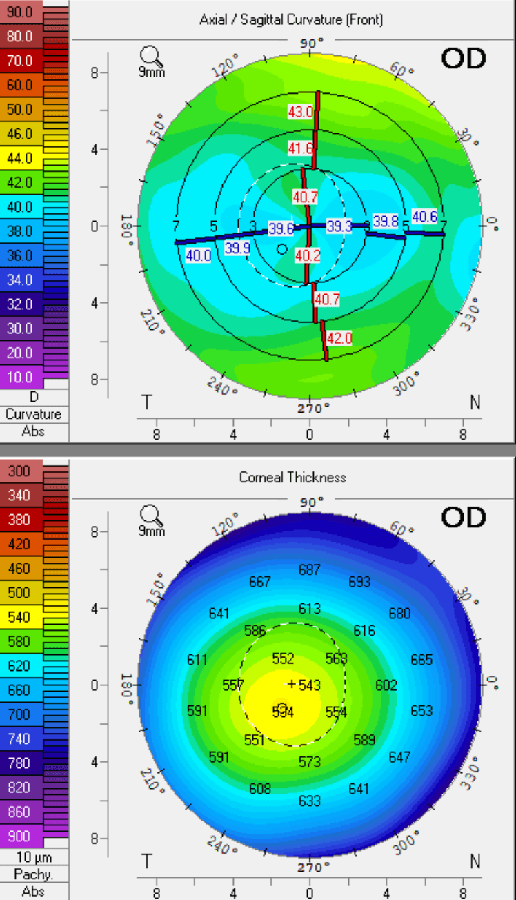 https://covalentcareers3.s3.amazonaws.com/media/original_images/decentered-old-LASIK-ablation.png