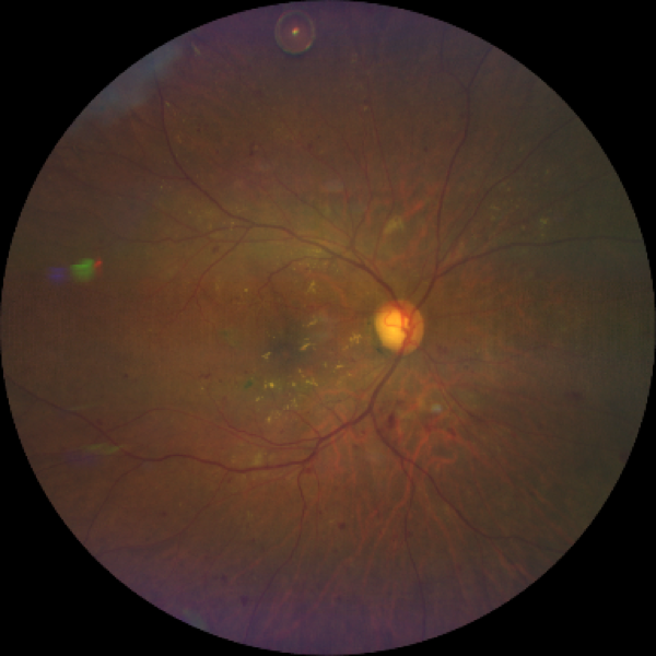 https://covalentcareers3.s3.amazonaws.com/media/original_images/diabetic-retinopathy-taken-with-CLARUS-500.png