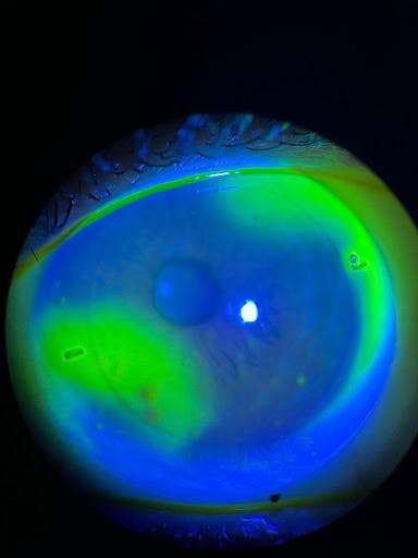 https://covalentcareers3.s3.amazonaws.com/media/original_images/fluorescein_shows_seepage.jpg