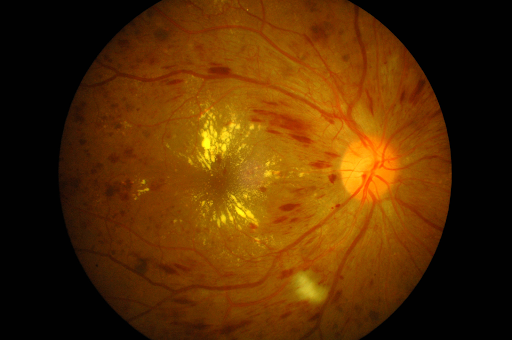 https://covalentcareers3.s3.amazonaws.com/media/original_images/fundus-photography-diabetic-retinopathy.png