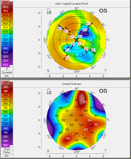 https://covalentcareers3.s3.amazonaws.com/media/original_images/hydrop_corneal_topography.png