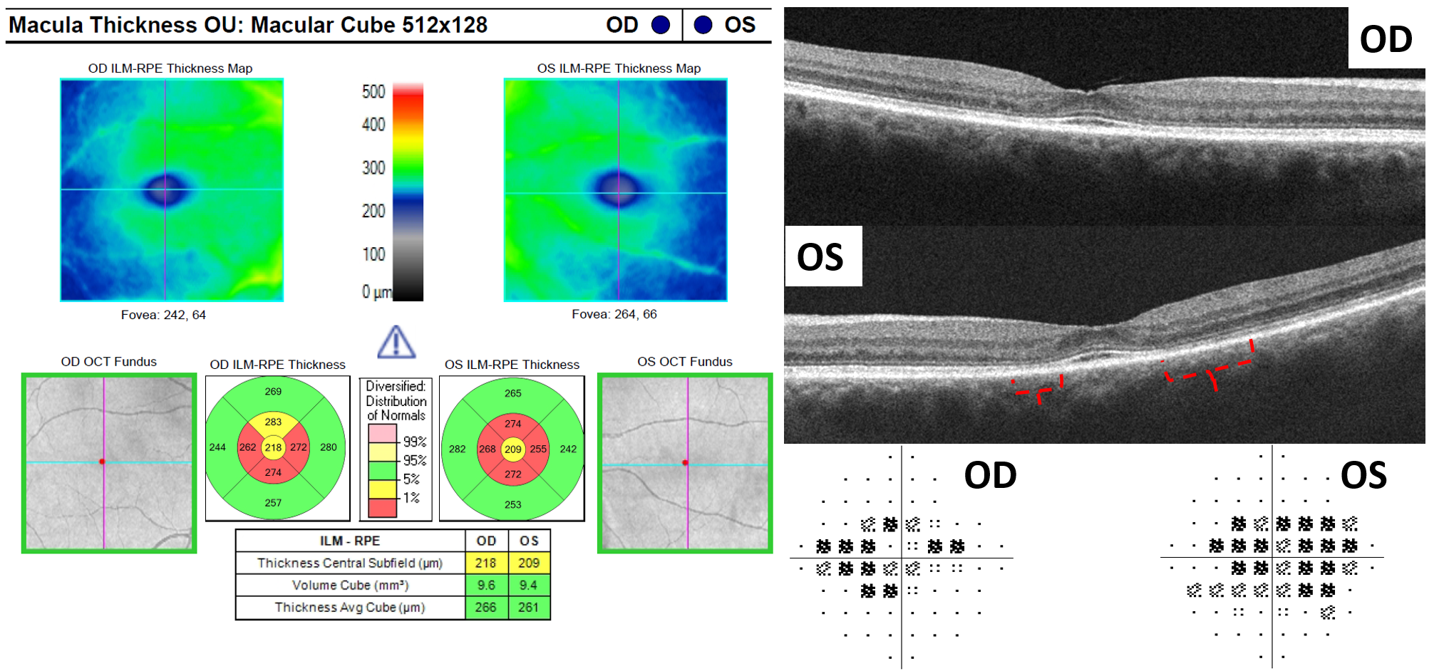 https://covalentcareers3.s3.amazonaws.com/media/original_images/hydroxychloroquine_retinopathy_OCT.png