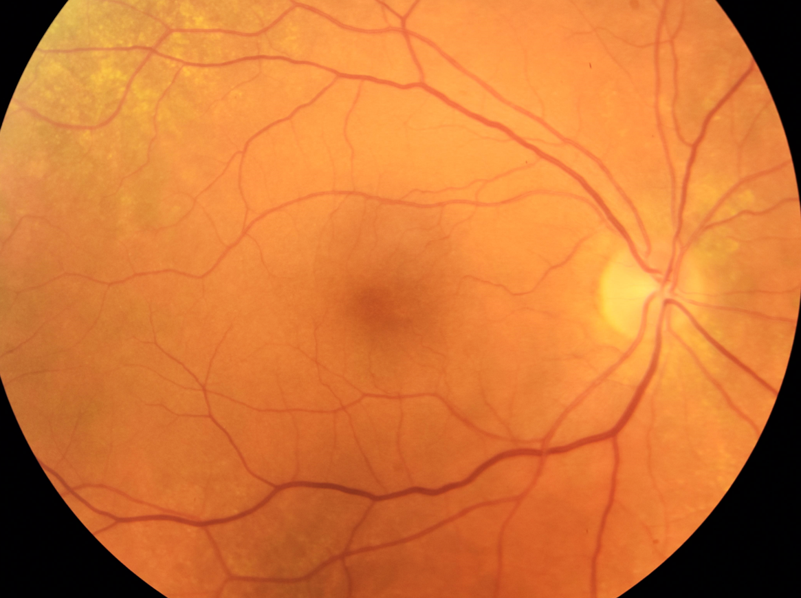 https://covalentcareers3.s3.amazonaws.com/media/original_images/hydroxychloroquine_retinopathy_fundus.png