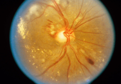 https://covalentcareers3.s3.amazonaws.com/media/original_images/hypertensive_retinopathy.png