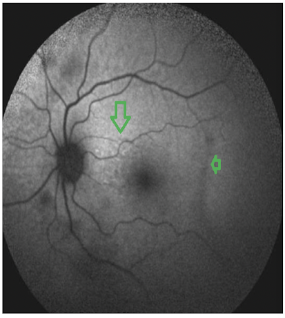 https://covalentcareers3.s3.amazonaws.com/media/original_images/hypopigmented_atrophic_retinal_changes.png