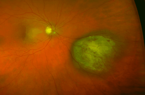 https://covalentcareers3.s3.amazonaws.com/media/original_images/intraocular_melanoma.png