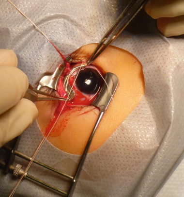 https://covalentcareers3.s3.amazonaws.com/media/original_images/intraoperative_plaque_insertion_retinoblastoma.png