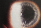 https://covalentcareers3.s3.amazonaws.com/media/original_images/keratic-precipitates-red-eye.png