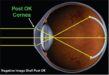 https://covalentcareers3.s3.amazonaws.com/media/original_images/myopia-control-orthokeratology.png