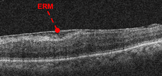 https://covalentcareers3.s3.amazonaws.com/media/original_images/oct-of-epiretinal-membrane.png