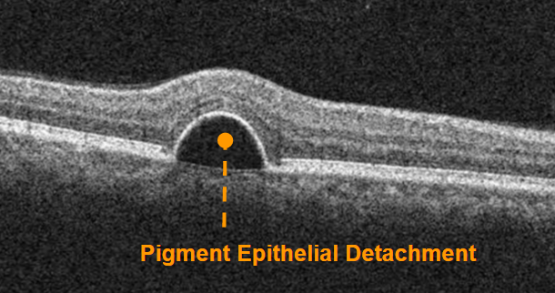 https://covalentcareers3.s3.amazonaws.com/media/original_images/oct-of-pigment-epithelial-detachment.png