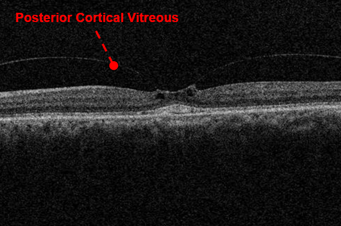 https://covalentcareers3.s3.amazonaws.com/media/original_images/oct-of-vitreomacular-traction-VMT.png