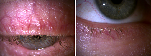 https://covalentcareers3.s3.amazonaws.com/media/original_images/ocular-rosacea-intrapalpebral-conjunctiva.png