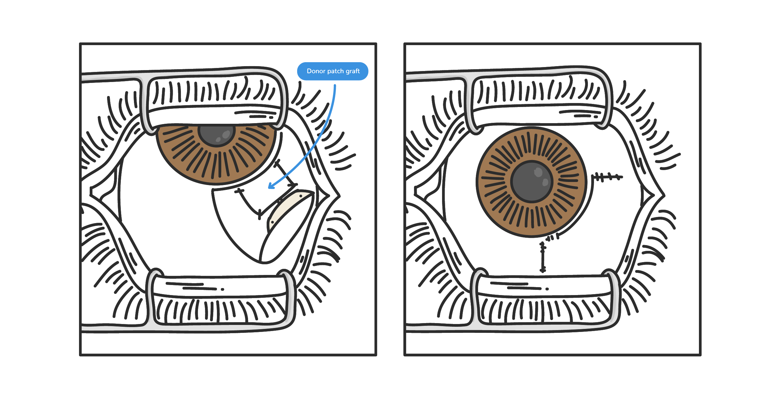 https://covalentcareers3.s3.amazonaws.com/media/original_images/patch_graft_tube_shunt.png