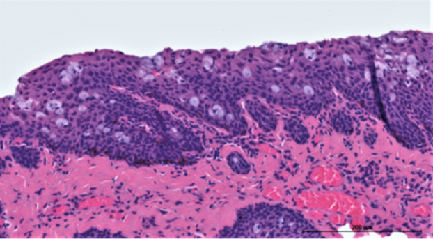 https://covalentcareers3.s3.amazonaws.com/media/original_images/pterygium-vs-pinguecula-what-to-know-and-how-to-treat-inread-image_2.png