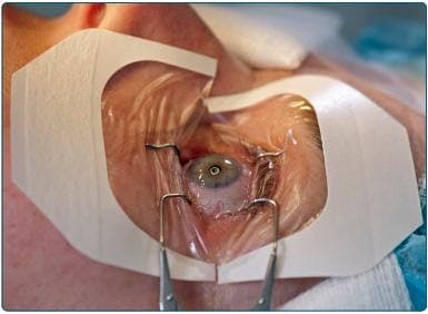 https://covalentcareers3.s3.amazonaws.com/media/original_images/refractive-surgery.jpg