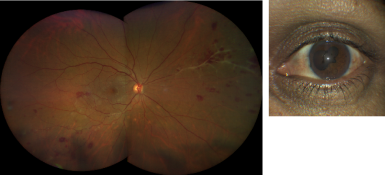 https://covalentcareers3.s3.amazonaws.com/media/original_images/retinal-vasculitis-taken-with-CLARUS-500-768x349.png