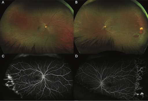 https://covalentcareers3.s3.amazonaws.com/media/original_images/temporal-intraretinal-hemorrhage.png